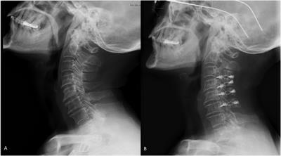 Relationship between spinocranial angle and clinical outcomes after laminoplasty in patients with ossification of the posterior longitudinal ligament